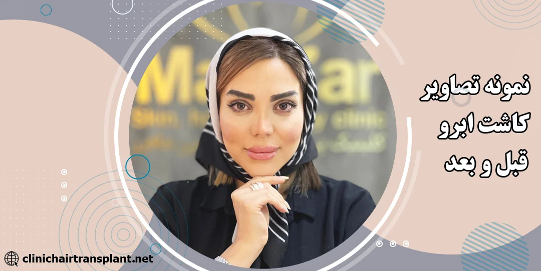 نتیجه کاشت ابرو بعد از یکسال + عکس | کلینیک مو و ابرو ماه زر نتیجه کاشت ابرو بعد از یکسال + عکس | کلینیک مو و ابرو ماه زر