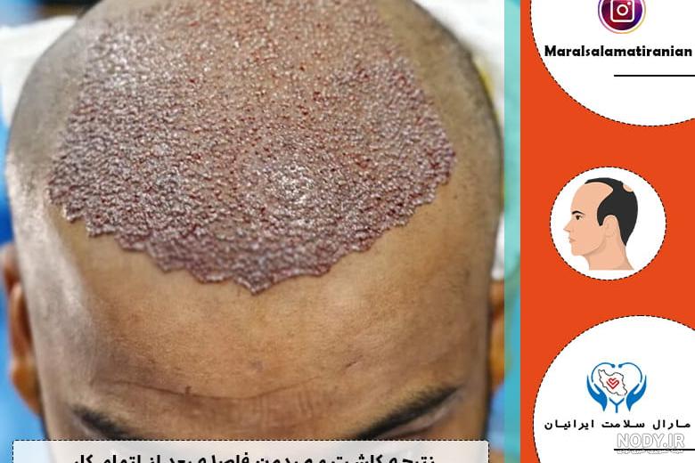 نتیجه کاشت مو بعد از 3 و 6 و 9 ماه (جدول زمانی چرخه رشد مو) | کلینیک مارال  سلامت ایرانیان