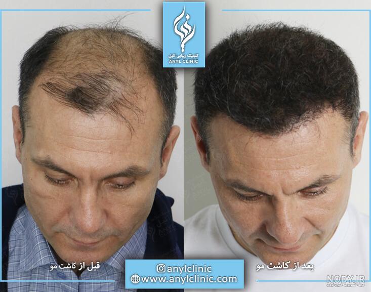 نتیجۀ کاشت مو: از یک هفته تا یک سال پس از کاشت - کاشت مو و ابرو ثمر