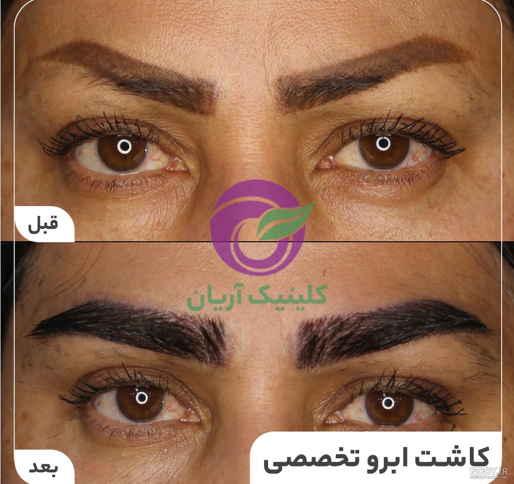 هزینه کاشت ابرو در سال 1403 + لیست جدید قیمت در تهران - دکتر سارا بهروان هزینه کاشت ابرو در سال 1403 + لیست جدید قیمت در تهران - دکتر سارا بهروان