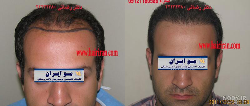 هزینه کاشت موی طبیعی چقدر است؟ | کلینیک فوق تخصصی کاشت مو دی