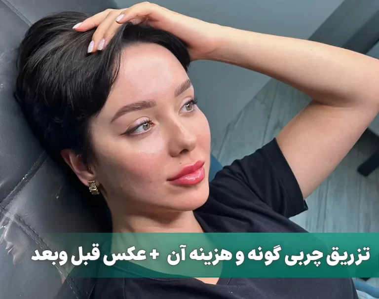 پروتز گونه چیست؟ همه چیز در مورد کاشت گونه و برجسته کردن گونه پروتز گونه چیست؟ همه چیز در مورد کاشت گونه و برجسته کردن گونه