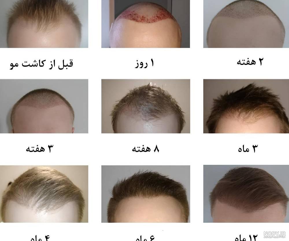 چرا موهای کاشته شده رشد نمی کنند؟ علت ریزش آن ها چیست