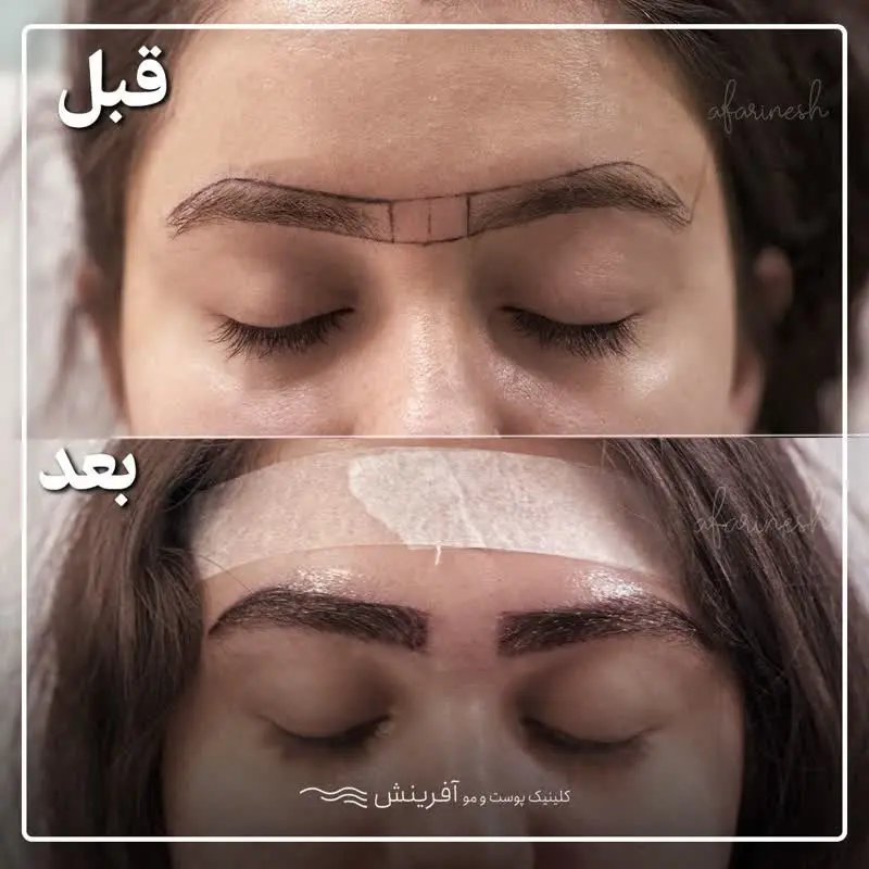 چگونه می توان ابروی کاشته شده را ضخیم تر کرد؟ | کلینیک رز چگونه می توان ابروی کاشته شده را ضخیم تر کرد؟ | کلینیک رز