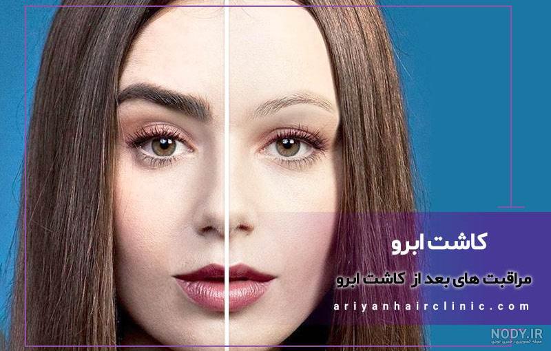 کاشت ابرو در اصفهان - هزینه ، ماندگاری ، عوارض کاشت ابرو در اصفهان - هزینه ، ماندگاری ، عوارض