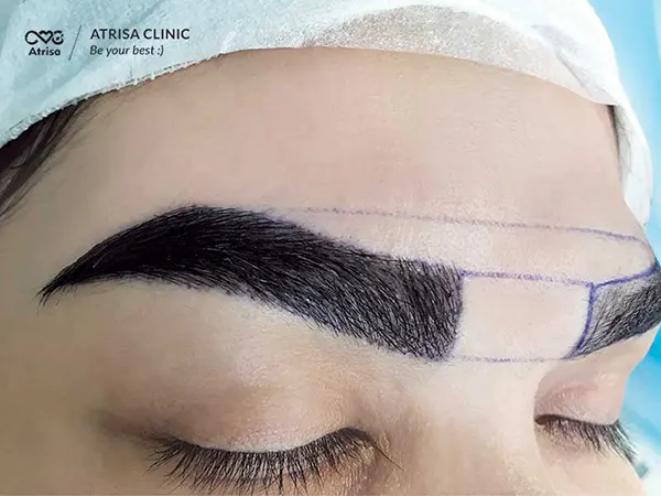 کاشت ابروی پهن | کلینیک رز کاشت ابروی پهن | کلینیک رز