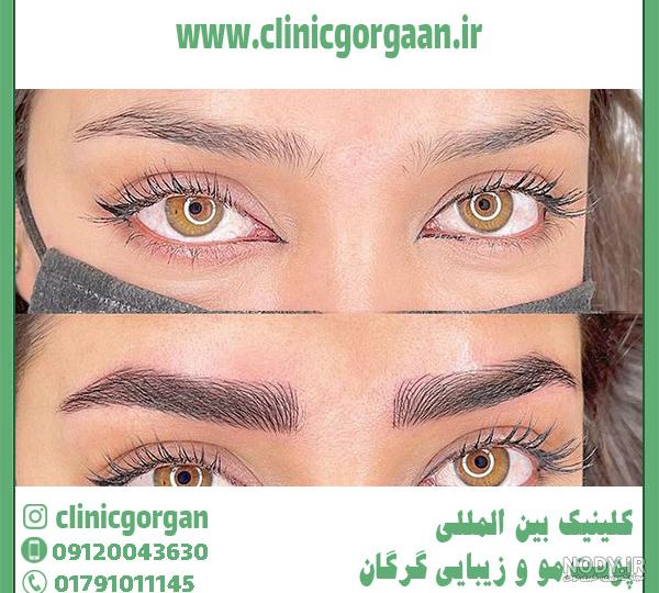 کاشت ابرو پهن دخترانه پرتراکم و طبیعی + عکس در بهترین کلینیک - دکتر سمیه زمانی نیا کاشت ابرو پهن دخترانه پرتراکم و طبیعی + عکس در بهترین کلینیک - دکتر سمیه زمانی نیا