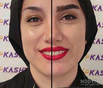 کاشت ابرو چگونه است - کلینیک تخصصی پوست و مو زیبایی گرگان کاشت ابرو چگونه است - کلینیک تخصصی پوست و مو زیبایی گرگان
