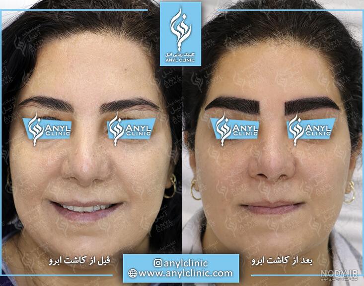 کاشت ابرو چگونه انجام می شود؟ (مطالب مهم و مفید+ مراقبت) | کلینیک تخصصی پوست و مو آتریسا کاشت ابرو چگونه انجام می شود؟ (مطالب مهم و مفید+ مراقبت) | کلینیک تخصصی پوست و مو آتریسا