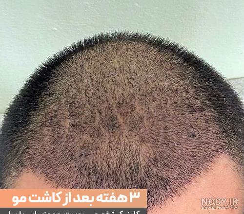کاشت مو ناموفق: علل، تشخیص و راهکارهای ترمیم