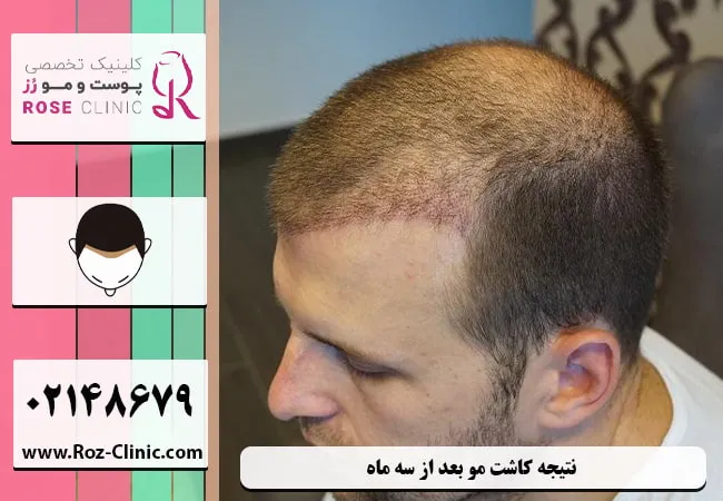 کاشت مو چگونه انجام می شود؟ انواع روش ها,عوارض - کلینیک دکتر پاکدل | بهترین  کلینیک زیبایی ایران و ترکیه