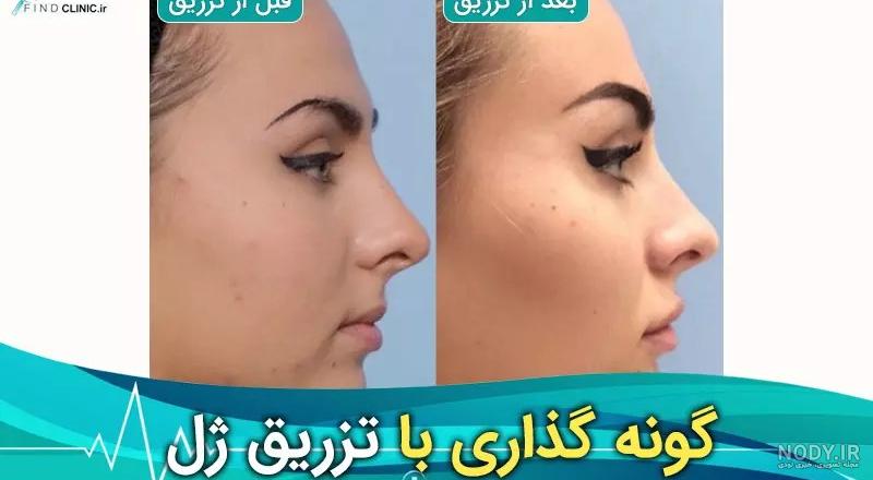 گونه گذاری با تزریق چربی | گونه گذاری با تزریق ژل | هزینه گونه گذاری | تزریق چربی گونه گذاری با تزریق چربی | گونه گذاری با تزریق ژل | هزینه گونه گذاری | تزریق چربی