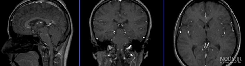 ام آر آی (MRI کاربرد آن در تشخیص بیماری‌های مغز و اعصاب - متخصص مغز و اعصاب  تهران- فوق تخصص بیماری های مغز و نخاع