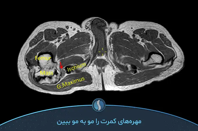 ام آر آی دیسک کمر چگونه انجام می‌شود؟ | دکتر یزدان پناهی