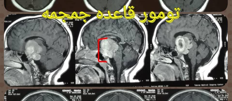 ام آر آی هیپوفیز : کاربرد، عوارض و مراقبت های لازم - مرکز تصویربرداری دکتر تقی لو ام آر آی هیپوفیز : کاربرد، عوارض و مراقبت های لازم - مرکز تصویربرداری دکتر تقی لو