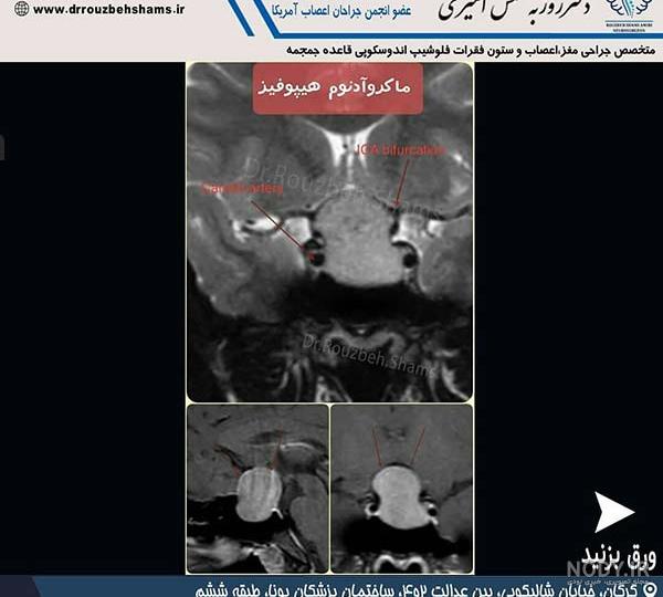 تومور هیپوفیز چیست و چطور تشخیص داده می شود؟ • تصویربرداری پزشکی بهار تومور هیپوفیز چیست و چطور تشخیص داده می شود؟ • تصویربرداری پزشکی بهار