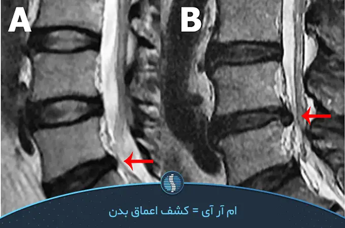 عکس ام ار ای از بیرون زدگی دیسک کمر | تصاویر واقعی + تفسیر عکس ام ار ای از بیرون زدگی دیسک کمر | تصاویر واقعی + تفسیر