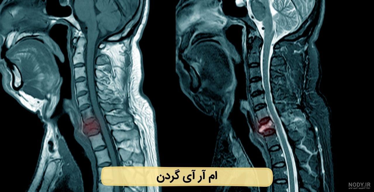عکس ام ار ای ستون فقرات - عکس نودی عکس ام ار ای ستون فقرات - عکس نودی