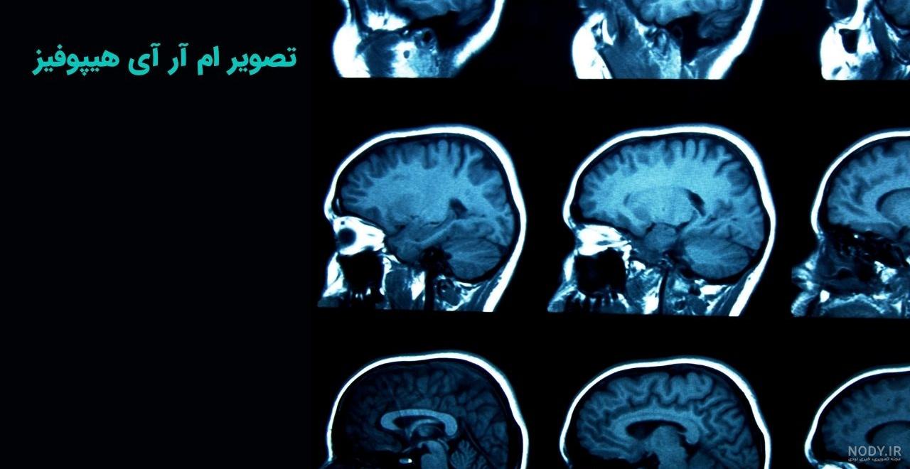 عکس ام ار ای غده هیپوفیز - عکس نودی عکس ام ار ای غده هیپوفیز - عکس نودی