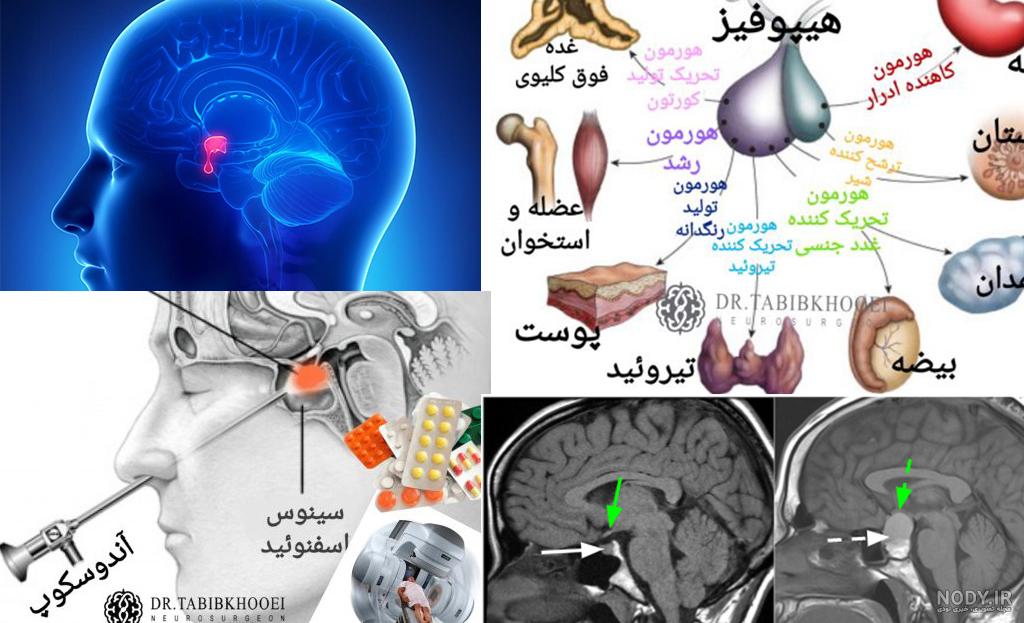 عکس ام ار ای غده هیپوفیز - عکس نودی عکس ام ار ای غده هیپوفیز - عکس نودی