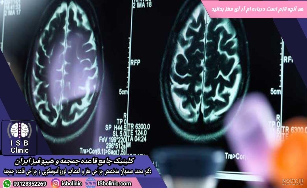 عکس غده هیپوفیز در ام ار ای عکس غده هیپوفیز در ام ار ای