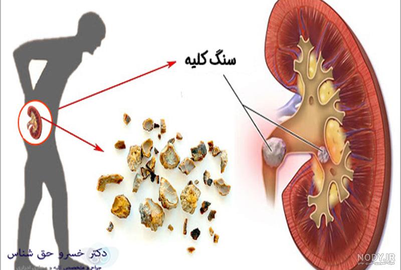 انواع سنگ کلیه و روش های درمان آن - دکتر حسین یوسف فام انواع سنگ کلیه و روش های درمان آن - دکتر حسین یوسف فام