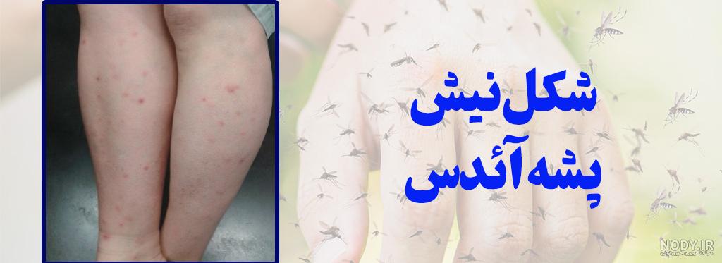 انواع و علائم نیش حشرات و راه های درمان | دکتر کاغذی انواع و علائم نیش حشرات و راه های درمان | دکتر کاغذی