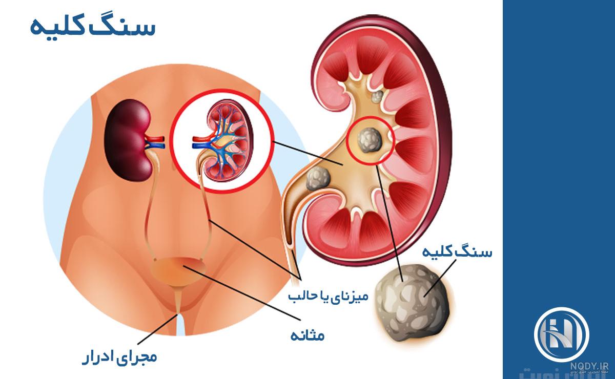 تشخیص سنگ کلیه با سونوگرافی یا رادیولوژی؟ - کلینیک تابناک تشخیص سنگ کلیه با سونوگرافی یا رادیولوژی؟ - کلینیک تابناک