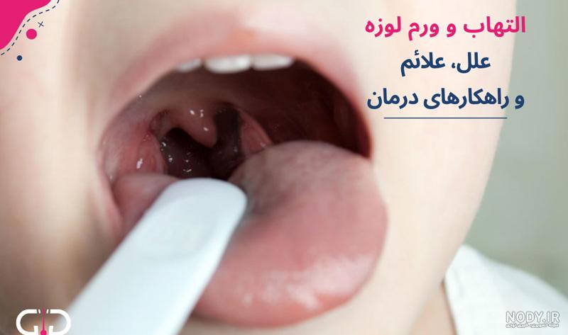 سرطان گلو و دانستنی‌های آن + آیا سرطان گلو کشنده است؟ | مجله هومکا