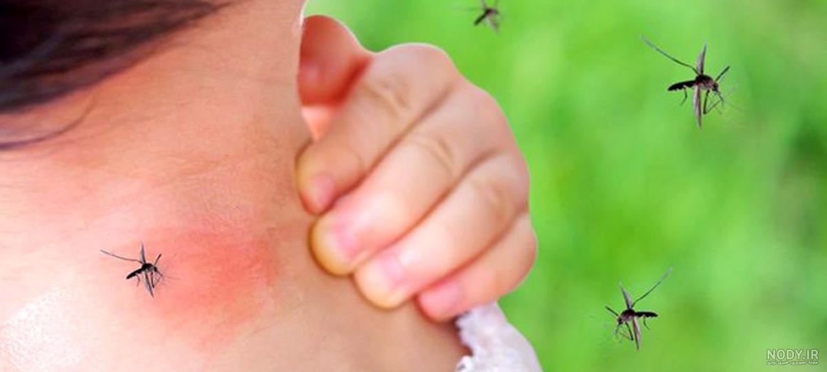 سمپاشی + تشخیص جای نیش حشرات و درمان ورم گزیدگی حشرات- سمپاشان