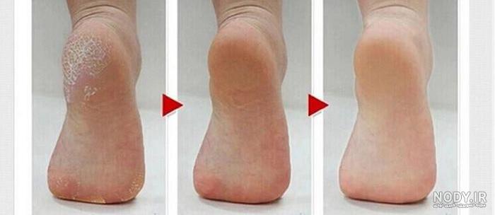 سنگ پا برقی شارژی سنگ پا برقی شارژی