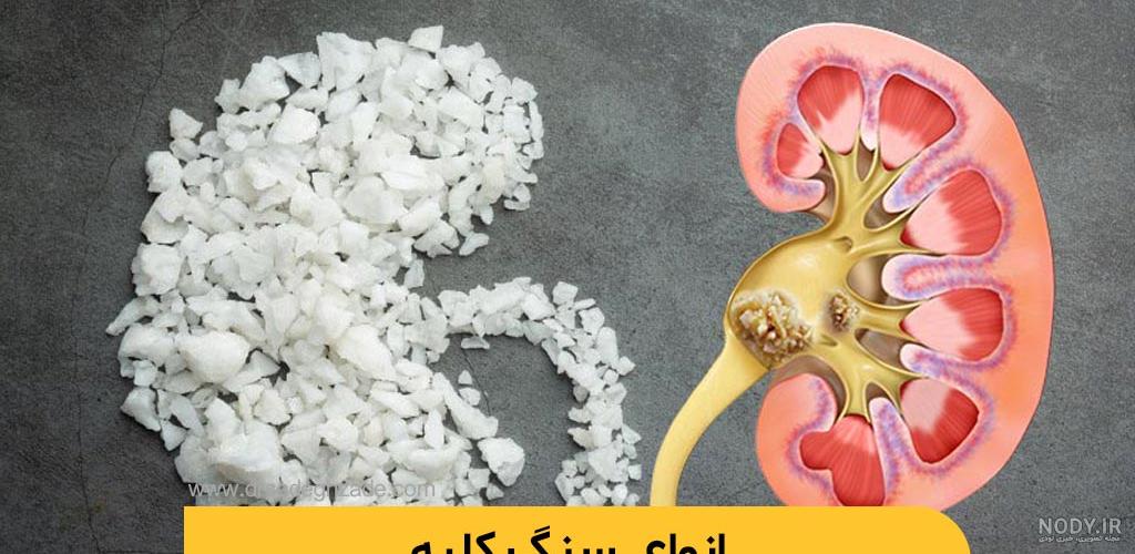 عکس سنگ در کلیه - عکس نودی عکس سنگ در کلیه - عکس نودی
