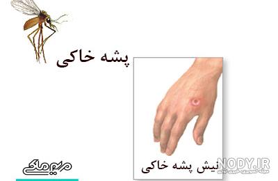 عکس گزش پشه سالک عکس گزش پشه سالک