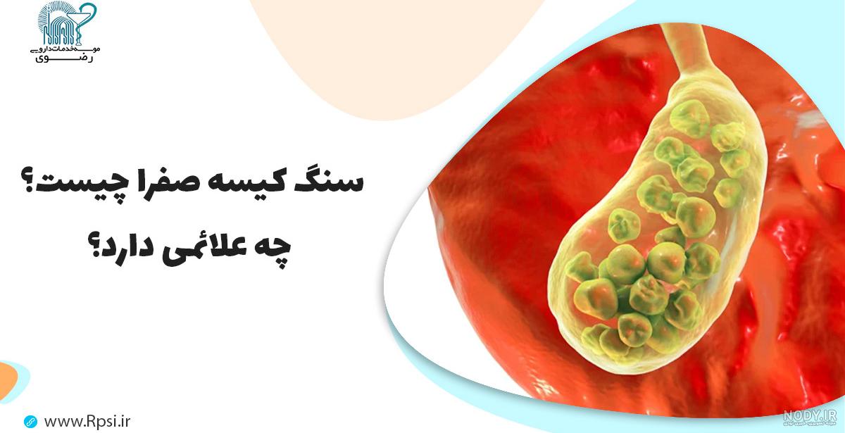 درباره علائم سنگ کیسه صفرا چه میدانید؟