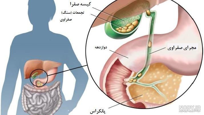 درمان سنگ مجاری کیسه صفرا به روش ای آر سی پی (ERCP)