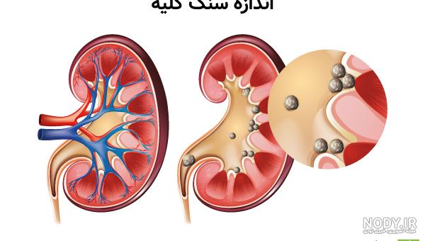 درمان سنگ های کوچک کلیه - دکتر مجتبی عاملی | فوق تخصص اندویورولوژی و لاپاراسکوپی | متخصص جراحی کلیه و مجاری ادراری درمان سنگ های کوچک کلیه درمان سنگ های کوچک کلیه - دکتر مجتبی عاملی | فوق تخصص اندویورولوژی و لاپاراسکوپی | متخصص جراحی کلیه و مجاری ادراری درمان سنگ های کوچک کلیه