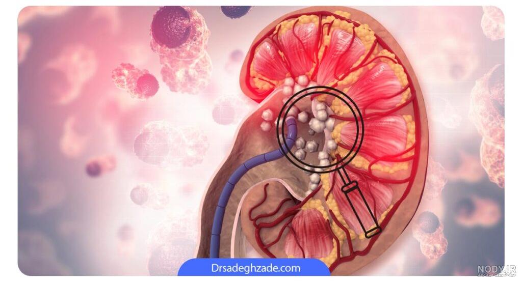 سنگ کلیه چیست؟ | علائم + راه های درمان سنگ کلیه چیست؟ | علائم + راه های درمان