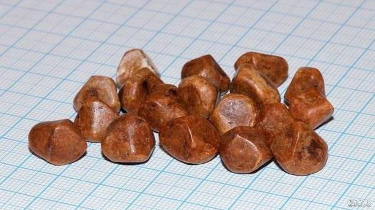 سنگ کیسه صفرا چه ارتباطی با عمل لاغری دارد؟ | دکتر طاها عنبرا متخصص جراحی  لاغری