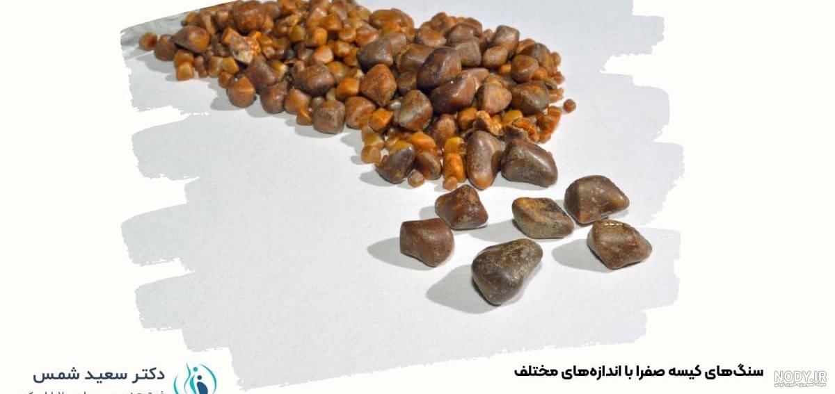 سنگ کیسه صفرا چیست و چه زمانی نیاز به جراحی دارد؟