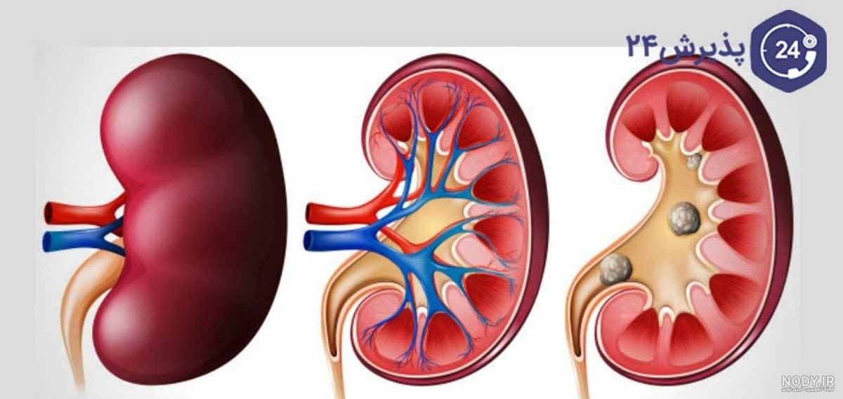 علائم سنگ کلیه چیست؟ و چگونه درمان می‌شود؟ | پذیرش۲۴