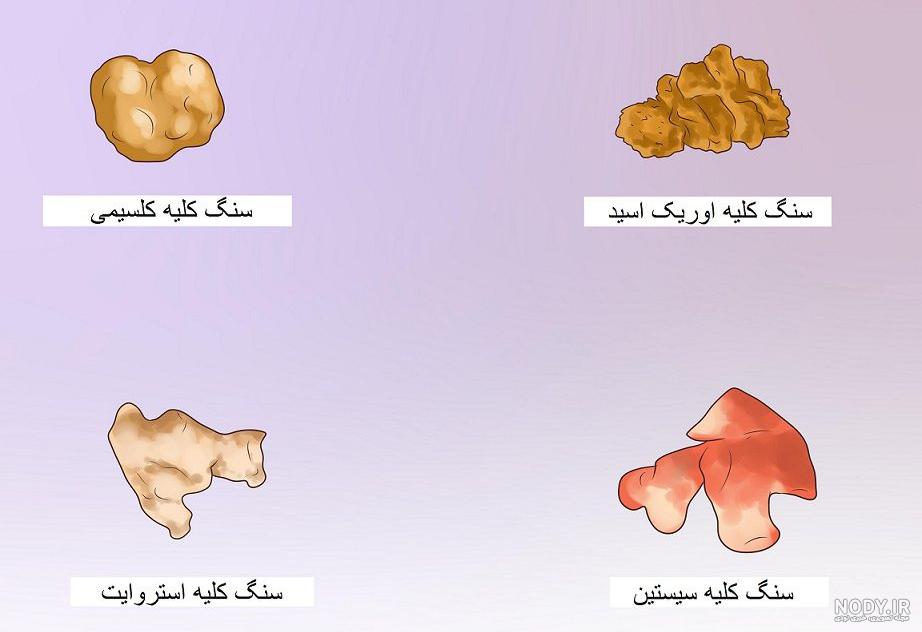 علت ایجاد سنگ کلیه در کودکان - تشخیص و درمان سنگ کلیه کودکان | دکتر بهار اشجعی علت ایجاد سنگ کلیه در کودکان - تشخیص و درمان سنگ کلیه کودکان | دکتر بهار اشجعی