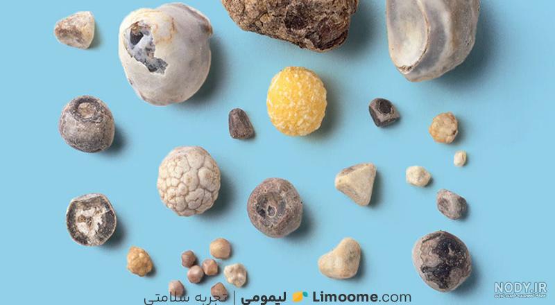 عمل لاپاراسکوپی کیسه صفرا | جراحی لاپاراسکوپی کیسه صفرا