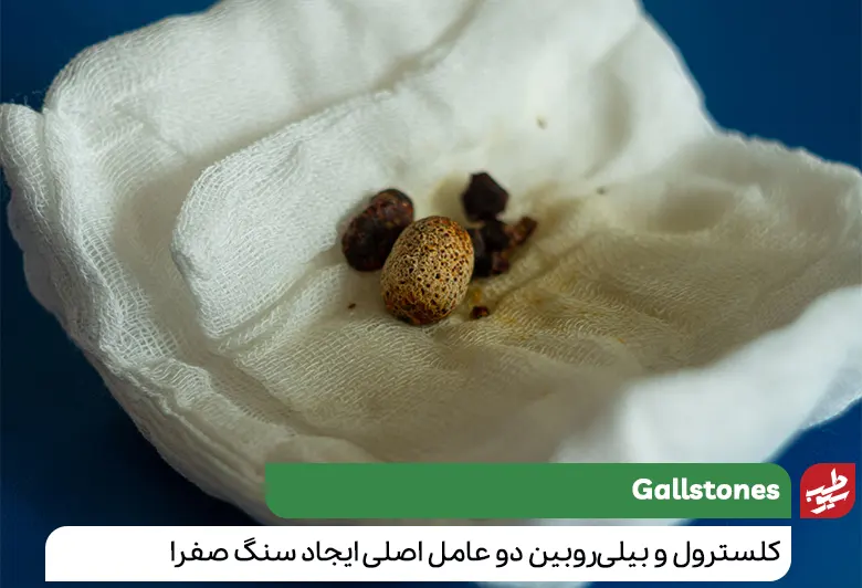 عکس از سنگ کیسه صفرا
