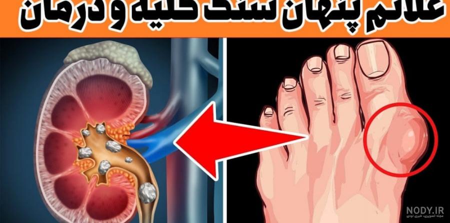 عکس سنگ کلیه 3 میلیمتری | دکتر حسین کرمی متخصص جراحی کلیه عکس سنگ کلیه 3 میلیمتری | دکتر حسین کرمی متخصص جراحی کلیه
