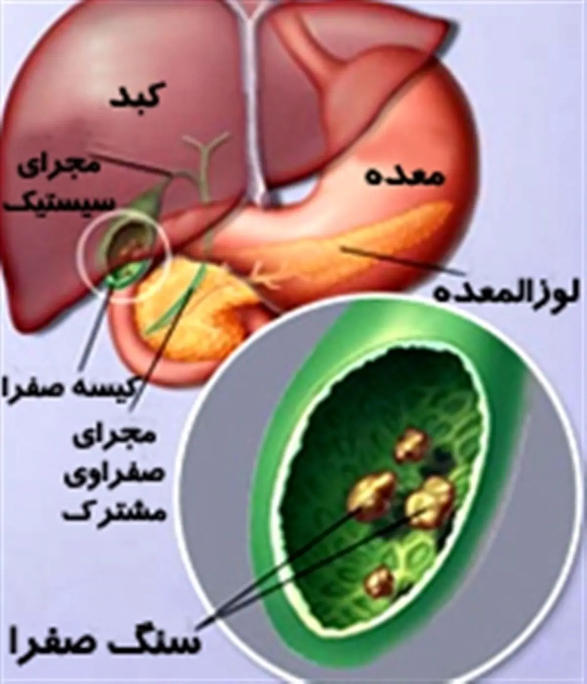 عکس های سنگ کیسه صفرا