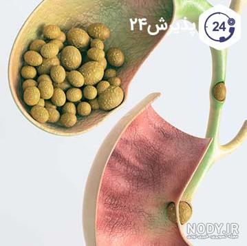 عکس سنگ در کیسه صفرا