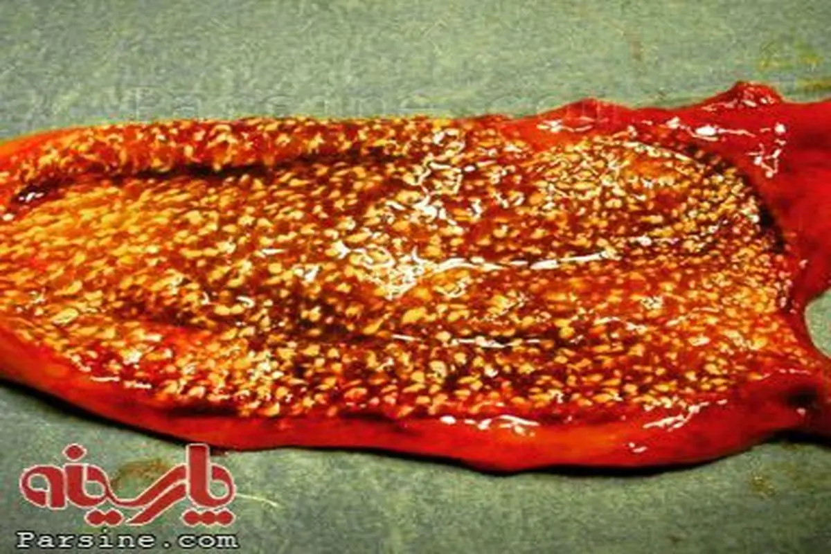 عکس سونوگرافی سنگ کیسه صفرا