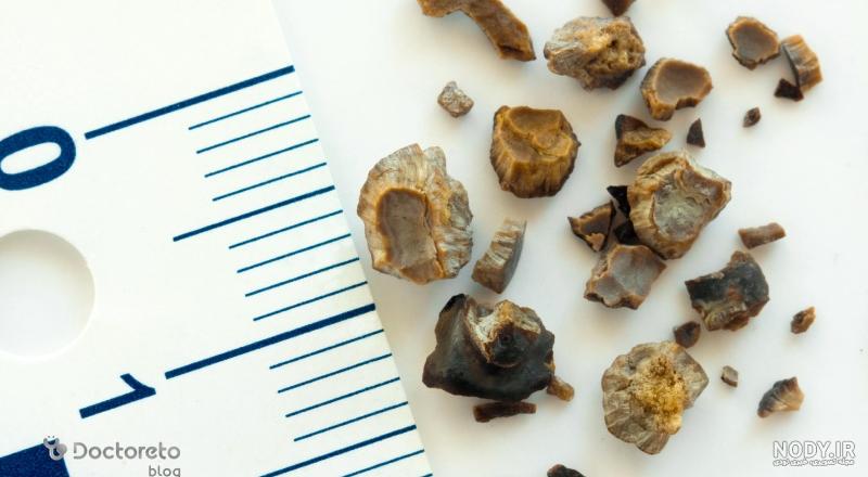 مهمترین علائم سنگ مثانه و سنگ کلیه در زنان - دکتر ولی پور متخصص ارولوژی مهمترین علائم سنگ مثانه و سنگ کلیه در زنان - دکتر ولی پور متخصص ارولوژی