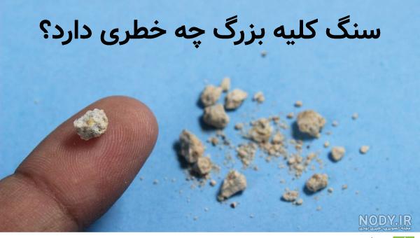 همه چیز درباره اندازه سنگ کلیه (جدول سنگ ها بر اساس سایز) - دکتر صادق زاده همه چیز درباره اندازه سنگ کلیه (جدول سنگ ها بر اساس سایز) - دکتر صادق زاده