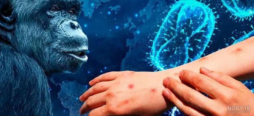 آشنایی با بیماری آبله میمون | تشخیص تا درمان آبله میمون | درمانگاه شبانه  روزی شهرآرا